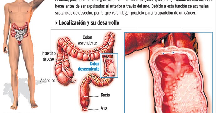 dieta postoperatoria tumor colon